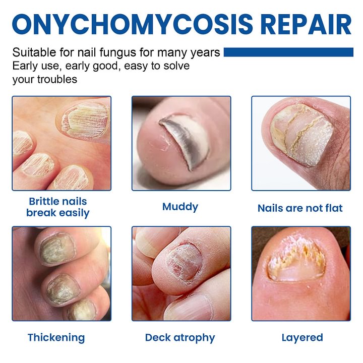 Ximonth® Onychomycosis Repair Patch✨🌿