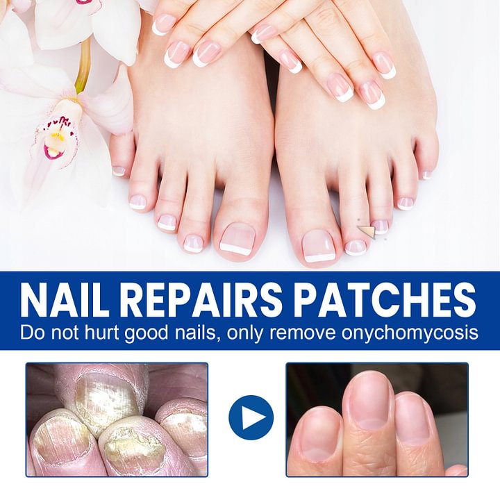Ximonth® Onychomycosis Repair Patch✨🌿