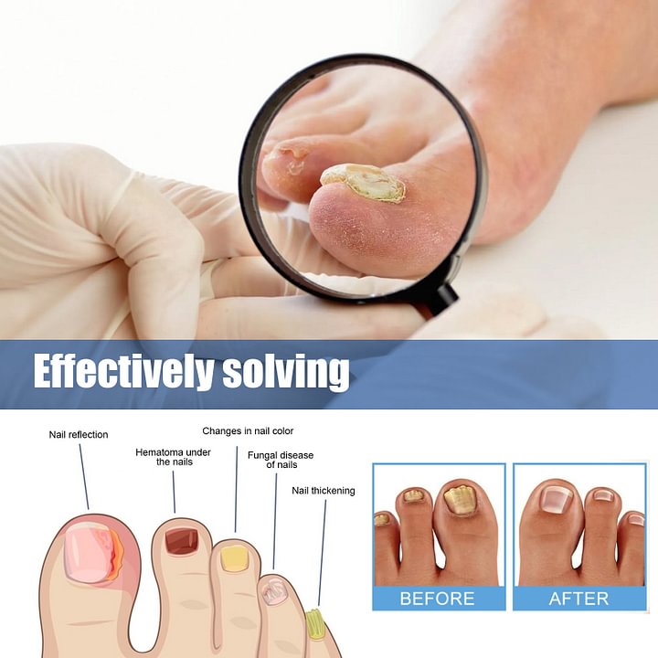 Ximonth® Onychomycosis Repair Patch✨🌿