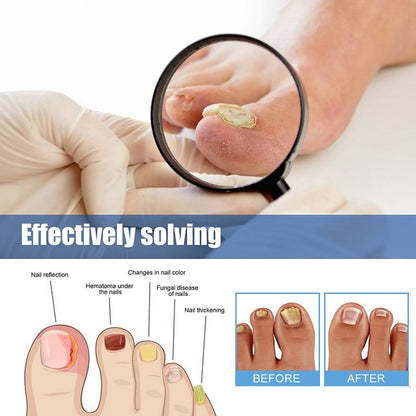 Ximonth® Onychomycosis Repair Patch✨🌿